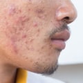 The Best Acne Treatments for Men: Expert Insights and Recommendations