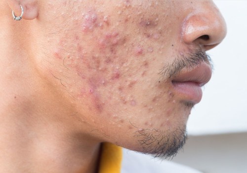 The Best Acne Treatments for Men: Expert Insights and Recommendations